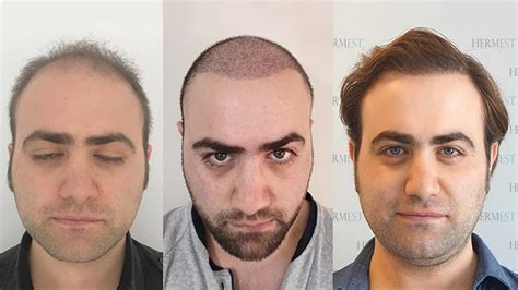 haartransplantation türkei hermest